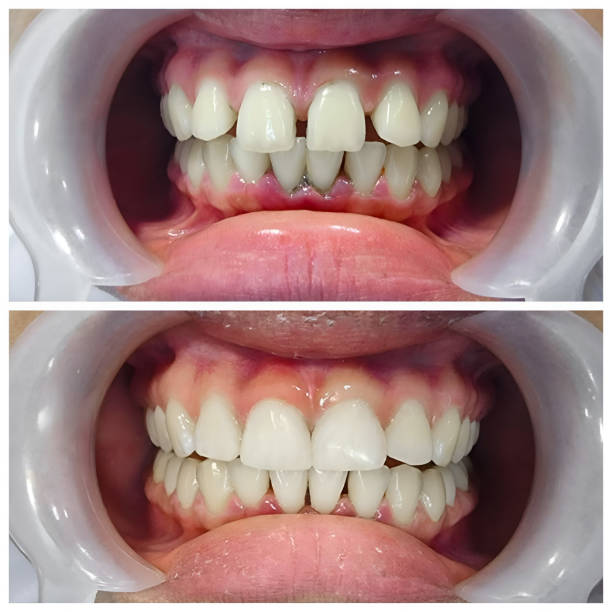 Full Mouth Reconstruction in Forest Heights, TX